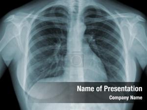 Lungs X ray PowerPoint Template