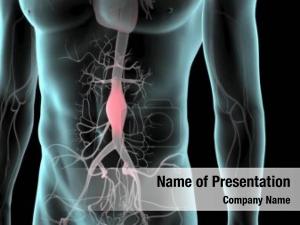 Aortic Aneurysm PowerPoint Template
