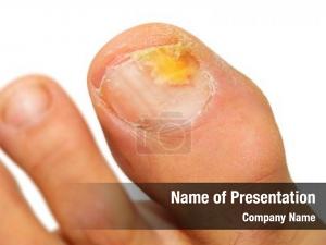 Infection onychomycosis fungal nail 