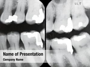 X rays left periodontal  