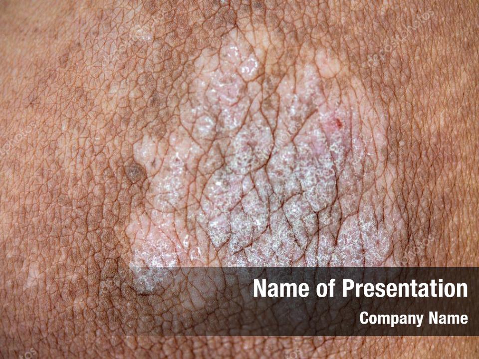 Skin, psoriasis man close 