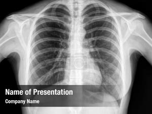 Human x ray image healthy chest