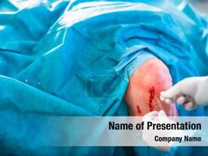 Orthopedic knee surgery, operation two PowerPoint Template