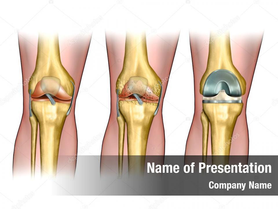 Knee replacement PowerPoint Template Knee replacement PowerPoint