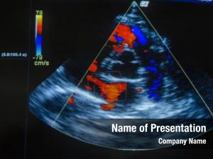 Computer heart ultrasound screen 