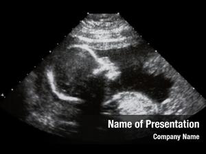 Old ultrasound months fetus 