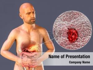 Peptic Ulcer Disease