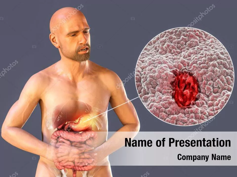 Peptic Ulcer Disease
