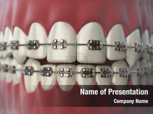 Brackets teeth braces open human