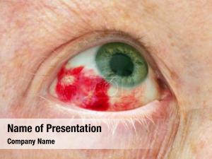 Hemorrhage in the eye 