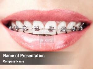 Teeth with braces or brackets