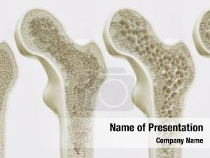 Rendering osteoporosis stages  